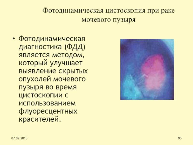 Фотодинамическая терапия рака. Лейкоплакия мочевого пузыря цистоскопическая картина. Флуоресцентная цистоскопия. Фотодинамическая диагностика мочевого пузыря. Фотодинамическая цистоскопия.